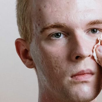 man cleaning up his acne