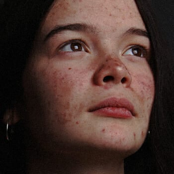 Close up image of a woman with acne