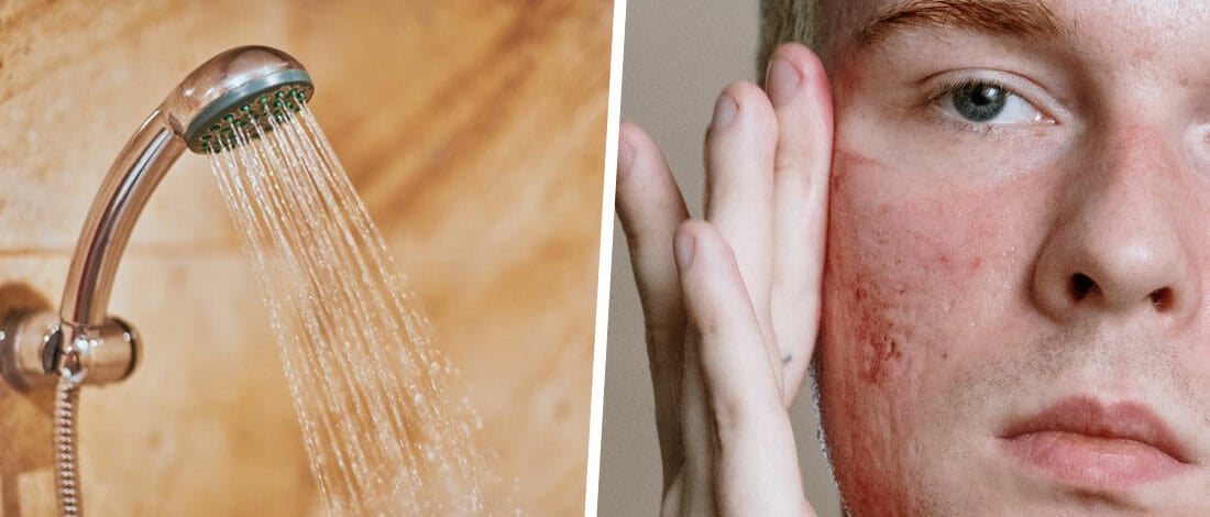 do-cold-showers-help-with-acne-or-they-make-it-worse