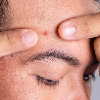 man with acne on his forehead