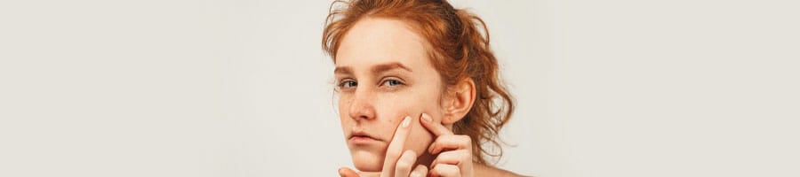 woman pointing out her face acne