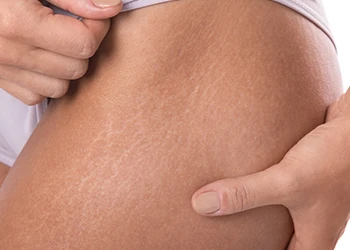 woman holding her leg and showing stretch marks