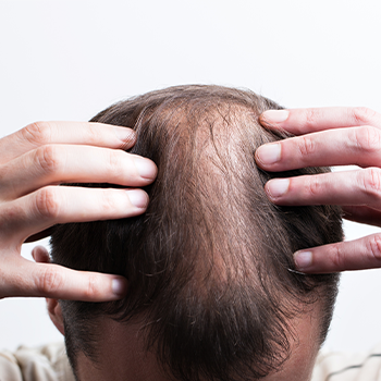 man with a patch on his head over losing hair