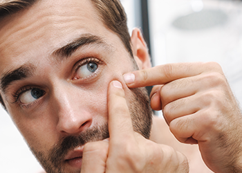 man pointing at his acne