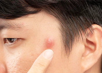 man pointing at his acne