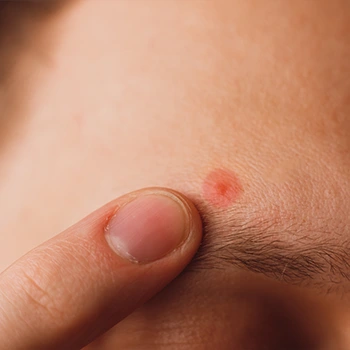 man pointing at his acne
