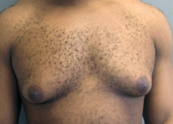 A person with soft breast tissues