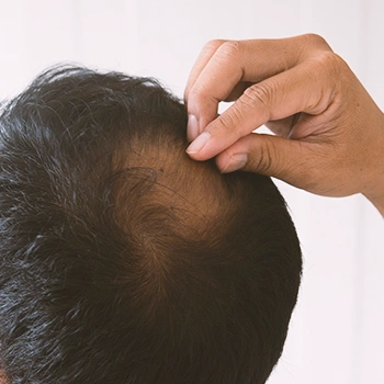 A man losing hair
