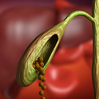 3D Gallstones obstructing