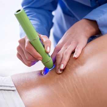 Laser therapy for stretch marks and scars