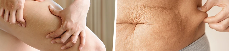 Cellulite around the body