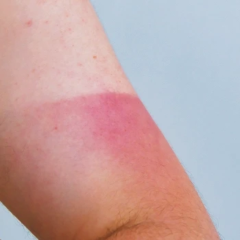 A woman's arm with severe skin redness