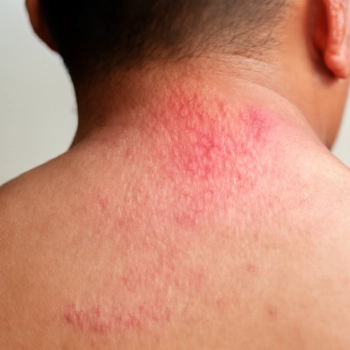 A person's back with steroid rashes