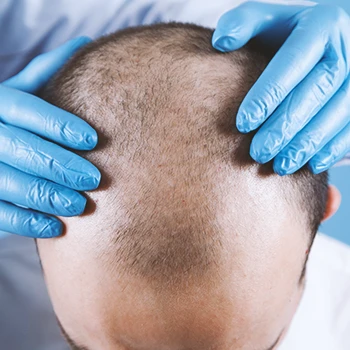 Top view of man with hair loss