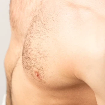 Excess body hair