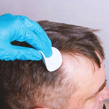 Close up shot of a doctor taking care of a balding head