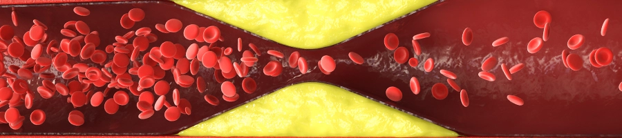 Cholesterol clogging the blood flow