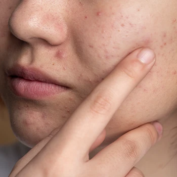 A woman with face acne