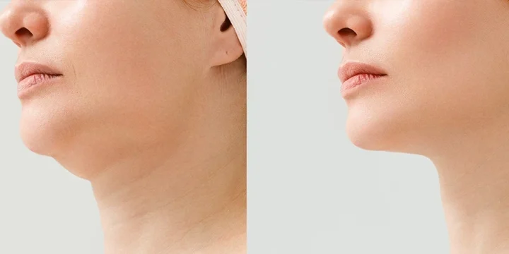 A before and after image after getting rid of neck fat