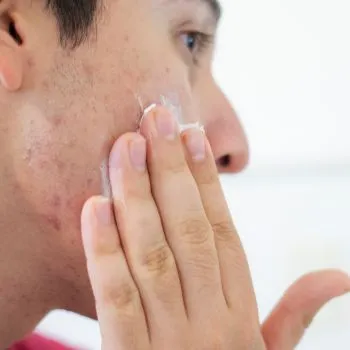 Close up of a man with acne